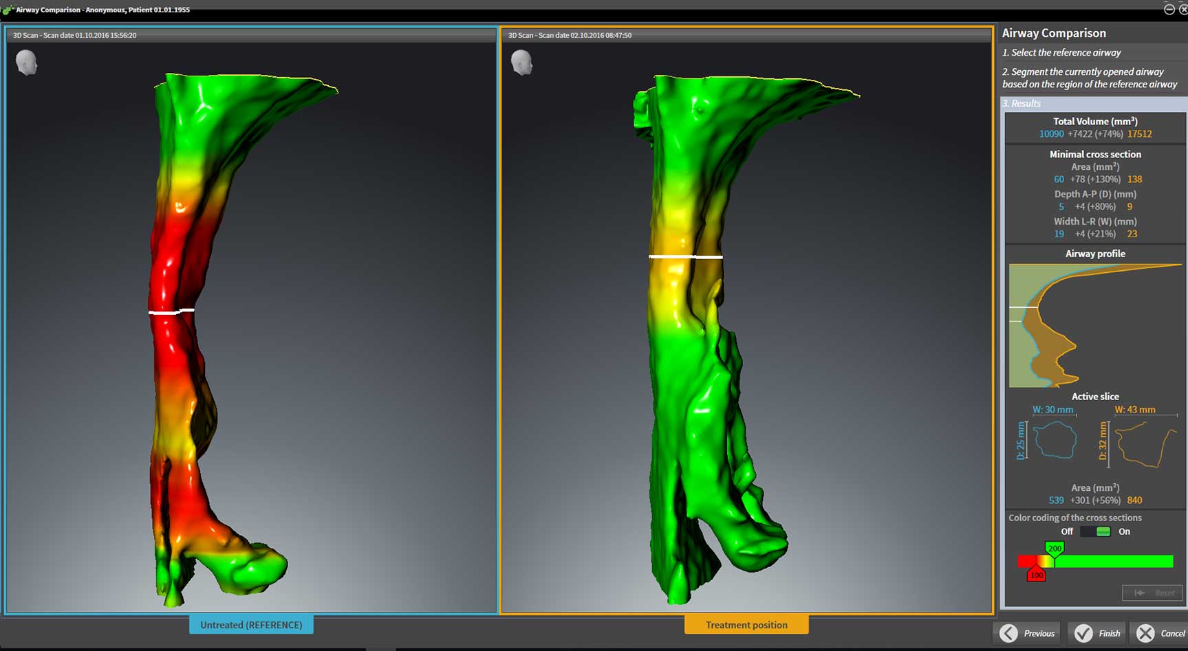 SICAT Airによる気道解析の3D画像