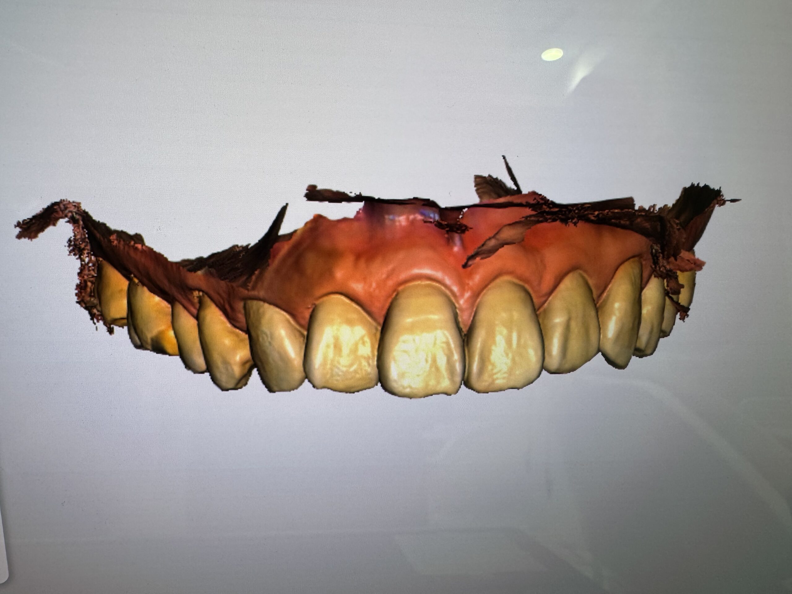 Prime Scanでスキャンした上顎の精密な3Dデータ（自費補綴用）