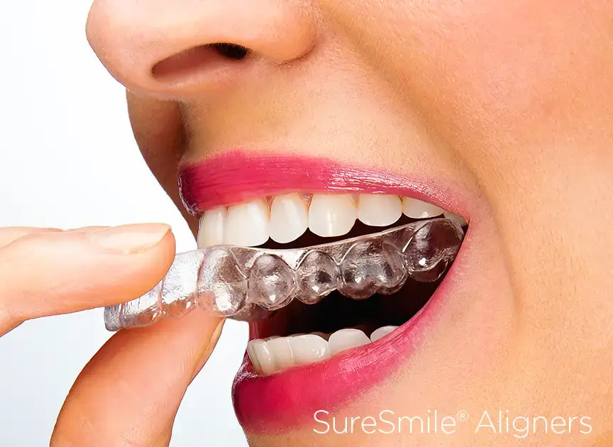 SureSmile（シュアスマイル）マウスピース矯正のイメージ