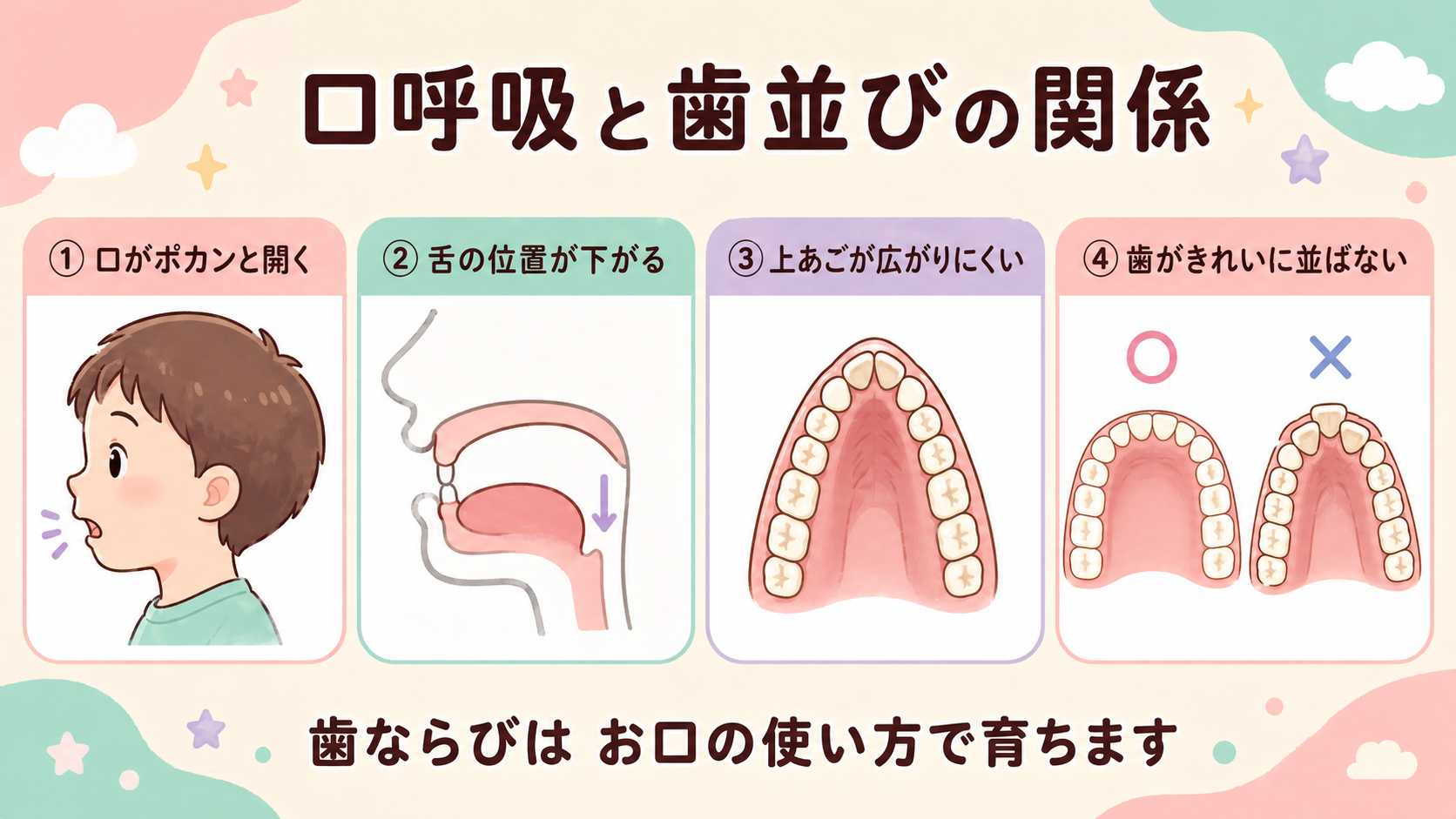 口呼吸で舌の位置が下がり、歯並びに影響する流れを示すイラスト
