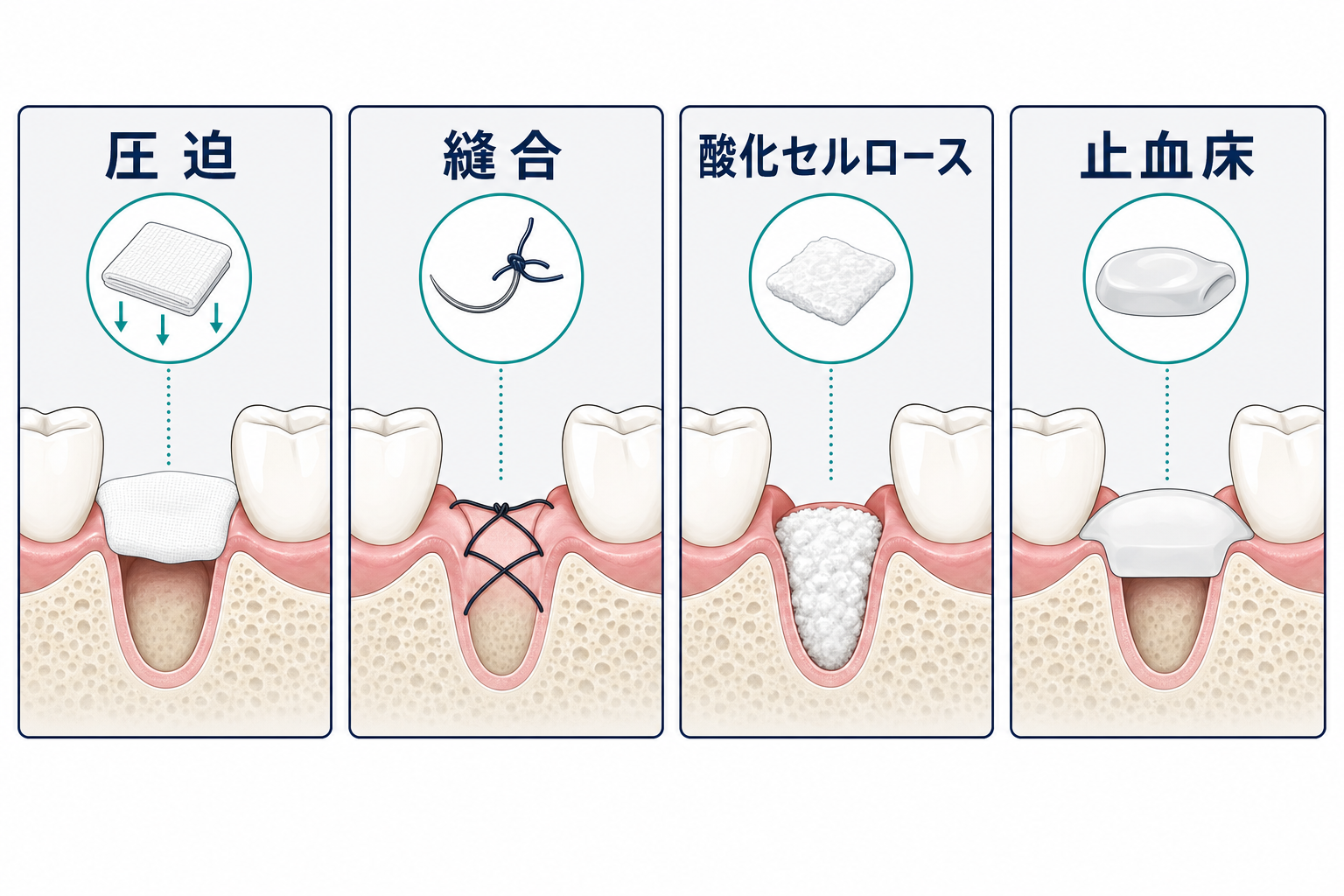 ガーゼ圧迫、縫合、酸化セルロース、止血床を示す臨床図