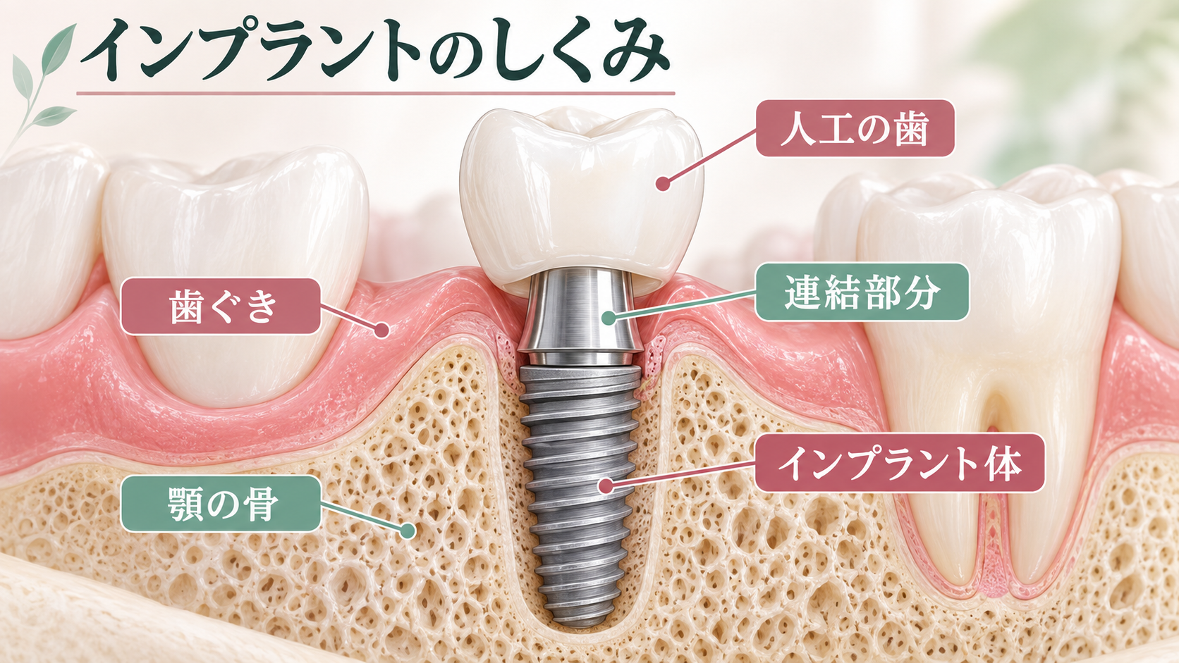 人工歯、連結部、インプラント体と顎の骨の関係を示す断面図